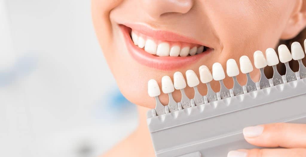 Veneers 1 Holly Dental Veeners 1 1
