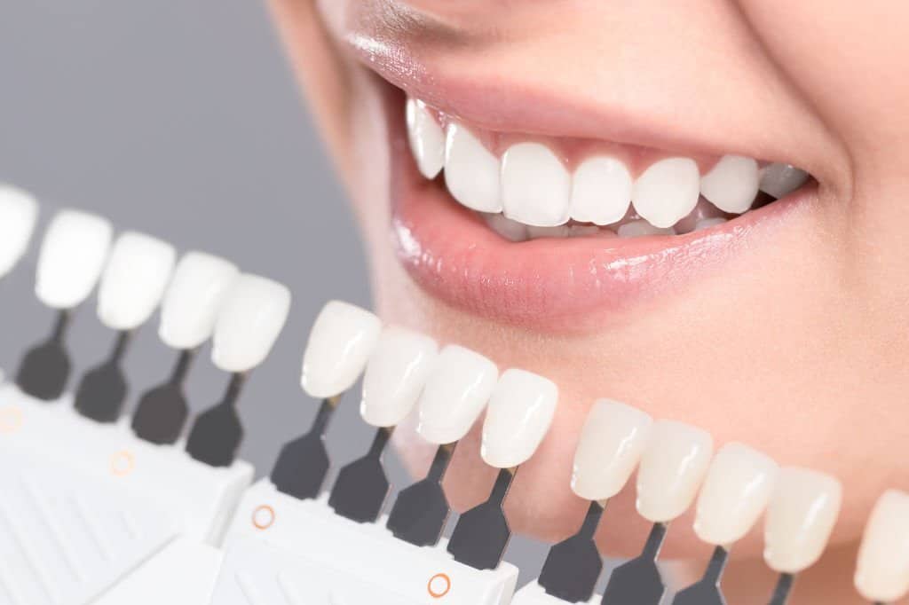 Emax 5 Holly Dental Veeners 1