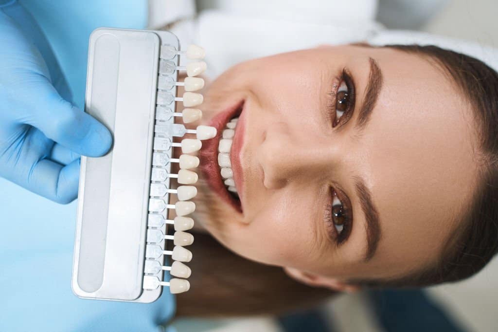 Veneers 3 Holly Dental Veeners 2