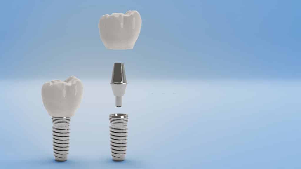 Zahnimplantate 4 Holly Dental Zahnimplantate 2